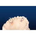 Anatomical Implant Restoration Crown